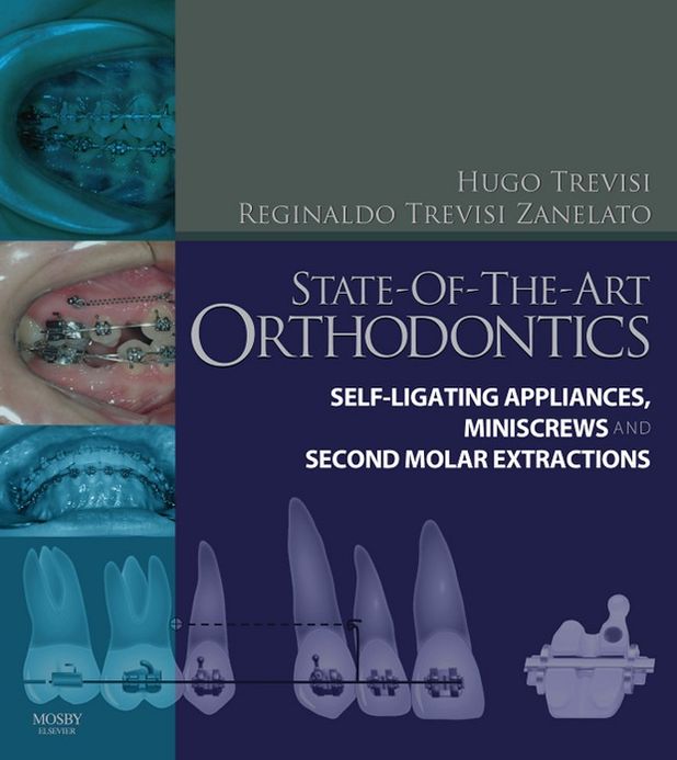 State-of-the-Art Orthodontics E-Book: Self-Ligating Appliances, Miniscrews and Second Molars Extraction
