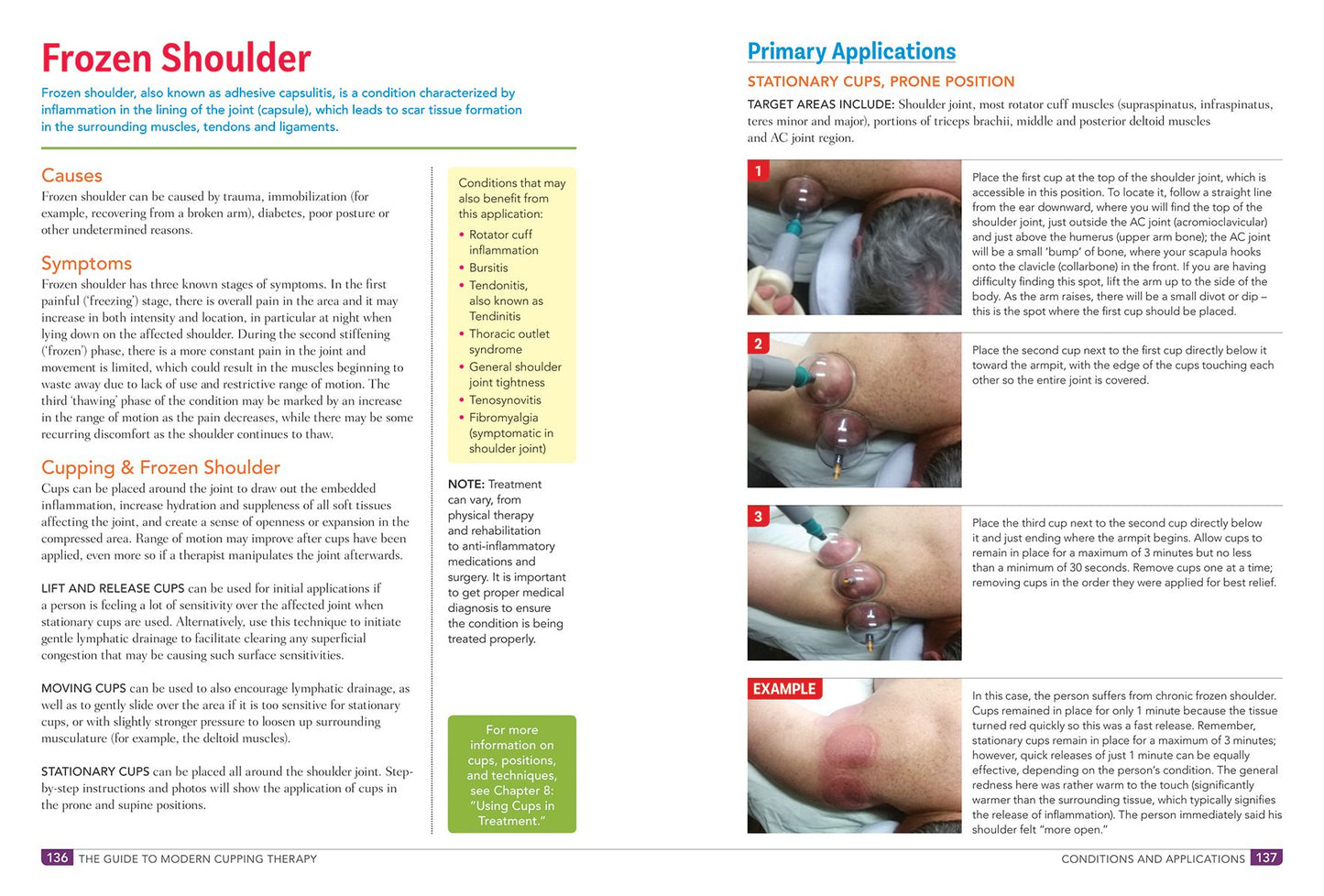 The Guide to Modern Cupping Therapy: Your Step-by-Step Source for Vacuum Therapy