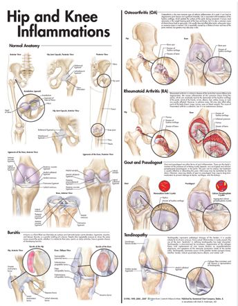 Hip and Knee Inflammations Anatomical Chart