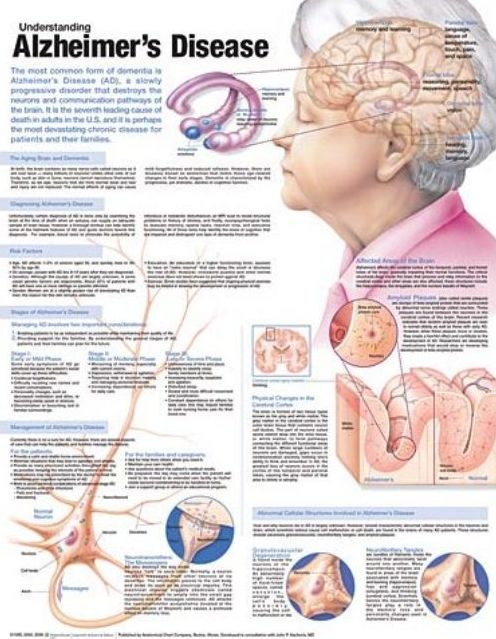 Understanding Alzheimer's Disease Anatomical Chart