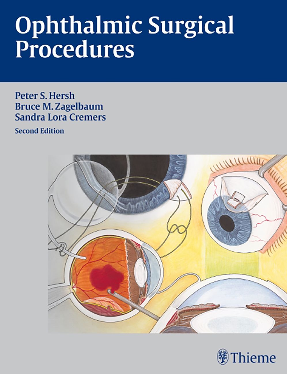 Ophthalmic Surgical Procedures