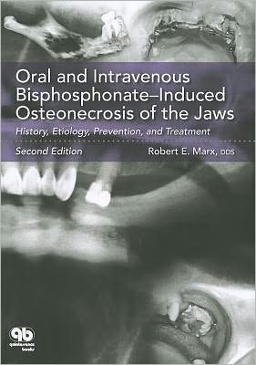 Oral and Intravenous Bisphosphonate-Induced Osteonecrosis of the Jaws: History, Etiology, Prevention, and Treatment