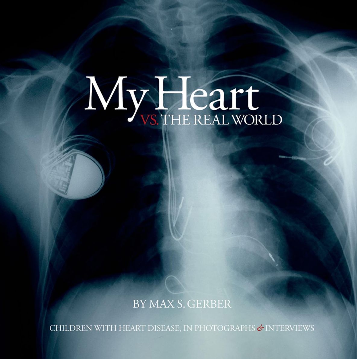 My Heart vs. the Real World: Children with Heart Disease, in Photographs and Interviews
