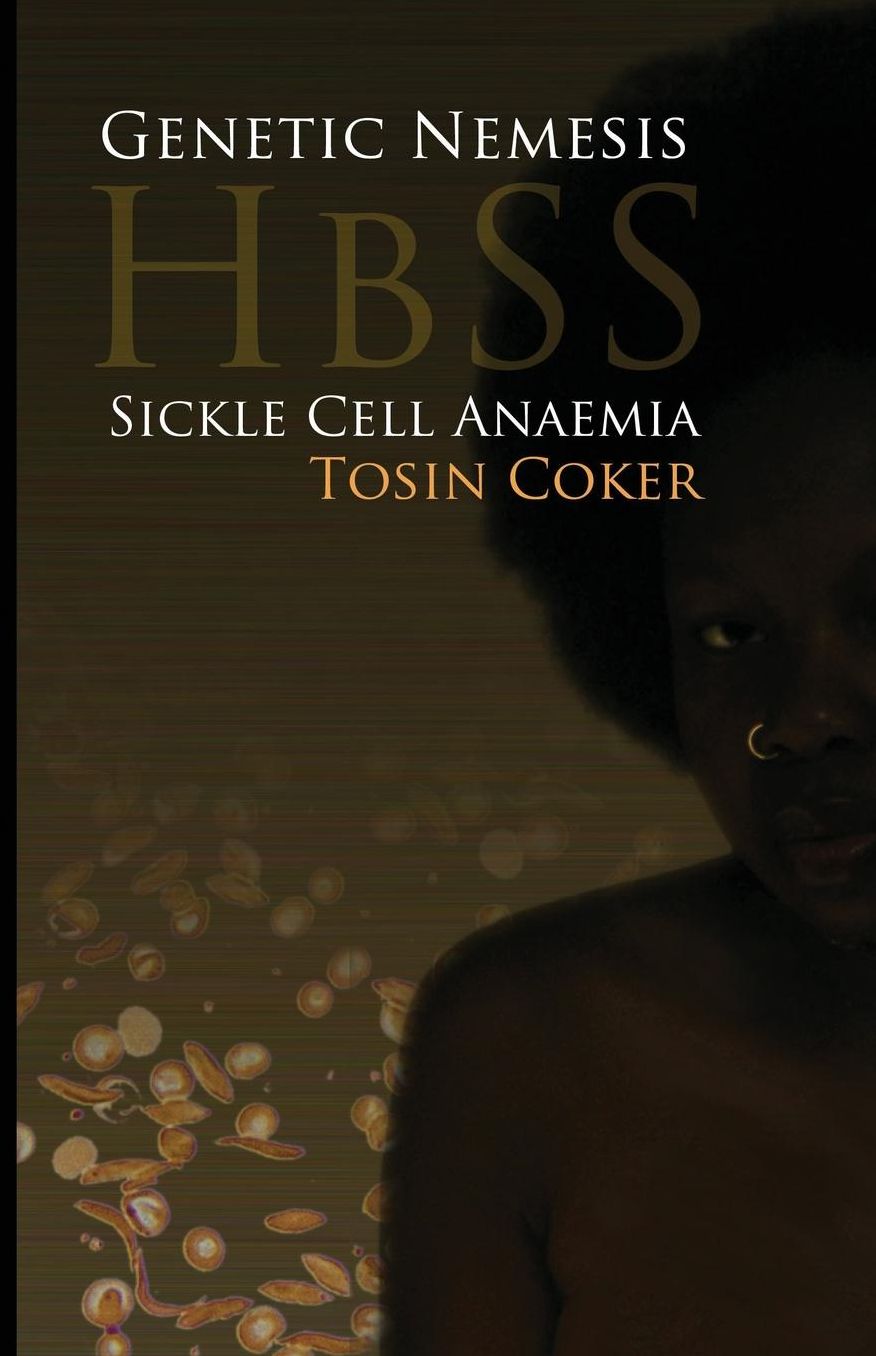 Genetic Nemesis Hbss Sickle Cell Anaemia