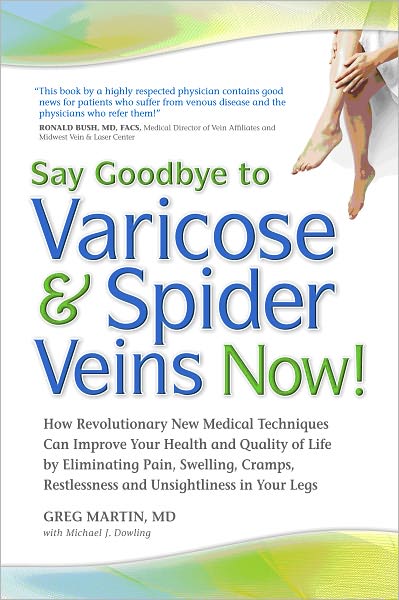 Say Goodbye to Varicose and Spider Veins Now!