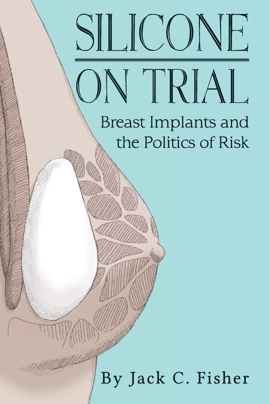 Silicone On Trial: Breast Implants and the Politics of Risk