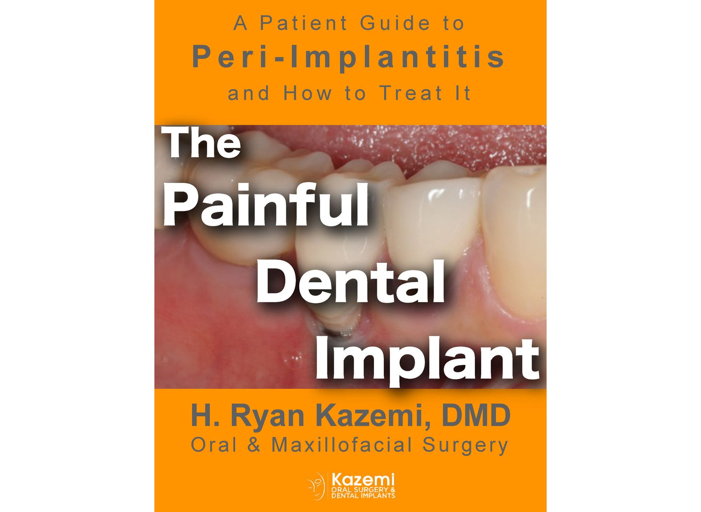 The Painful Dental Implant: Patient's Guide to Peri-Implantitis