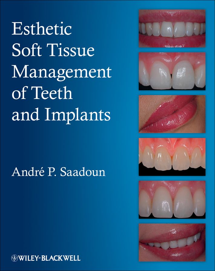 Esthetic Soft Tissue Management of Teeth and Implants