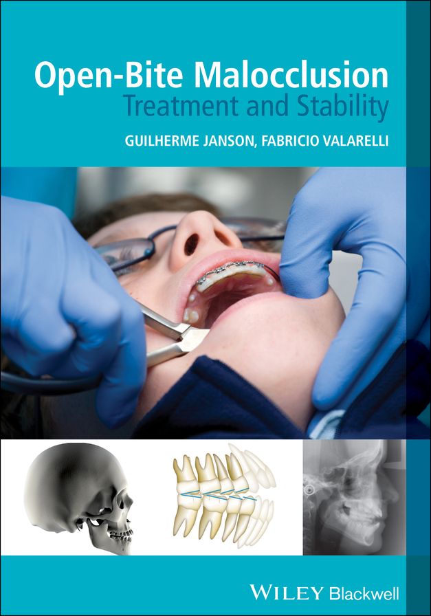 Open-Bite Malocclusion: Treatment and Stability