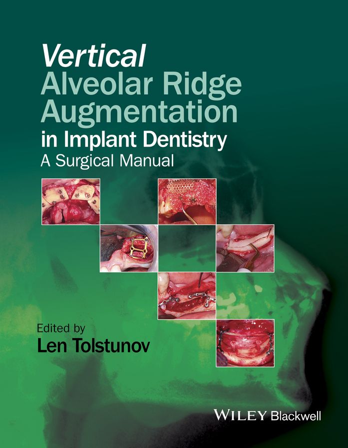 Vertical Alveolar Ridge Augmentation in Implant Dentistry: A Surgical Manual
