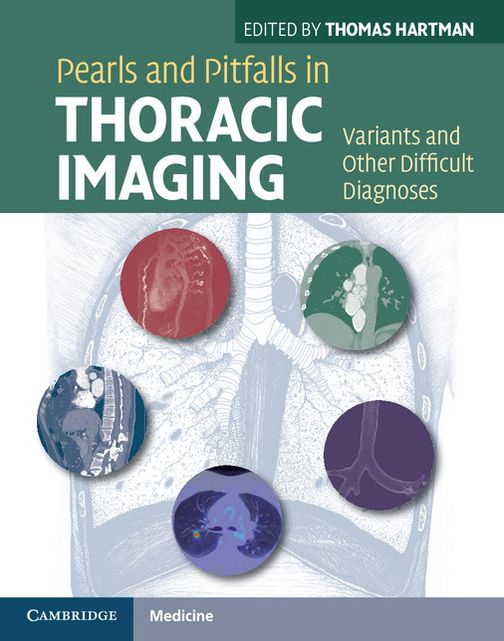 Pearls and Pitfalls in Thoracic Imaging: Variants and Other Difficult Diagnoses