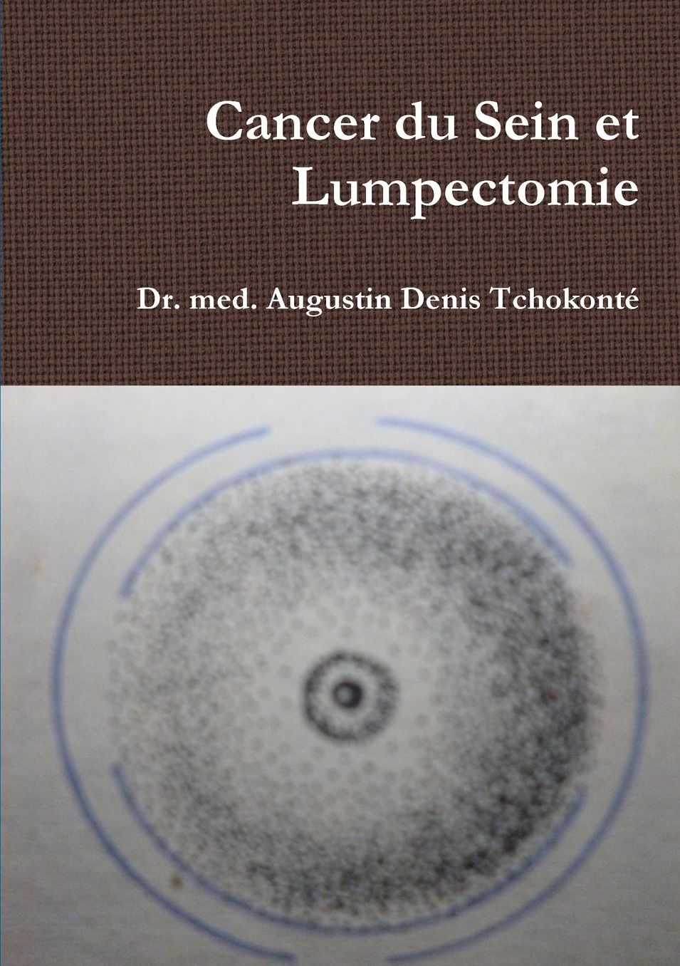 Cancer Du Sein Et Lumpectomie