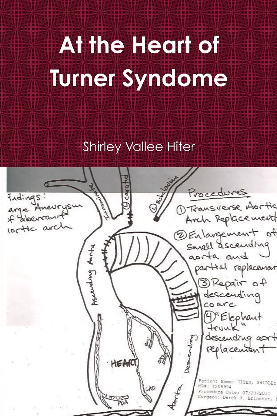 At the Heart of Turner Syndrome