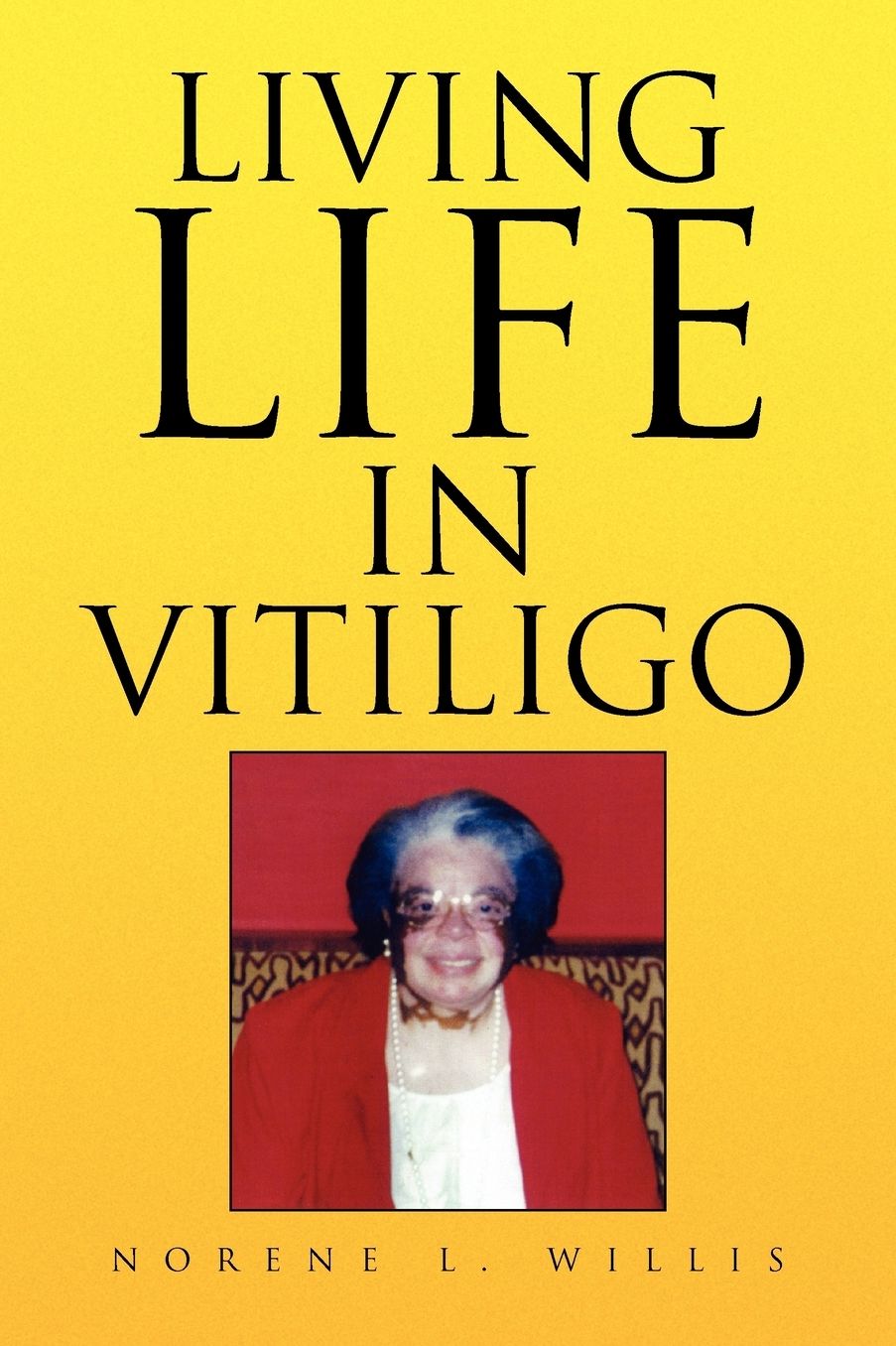 Living Life In Vitiligo