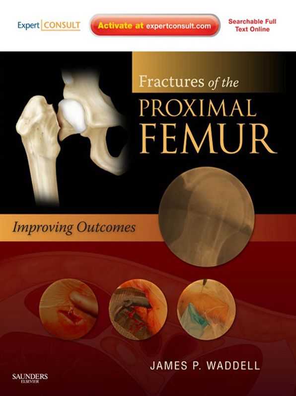 Fractures of the Proximal Femur: Improving Outcomes E-Book: Expert Consult