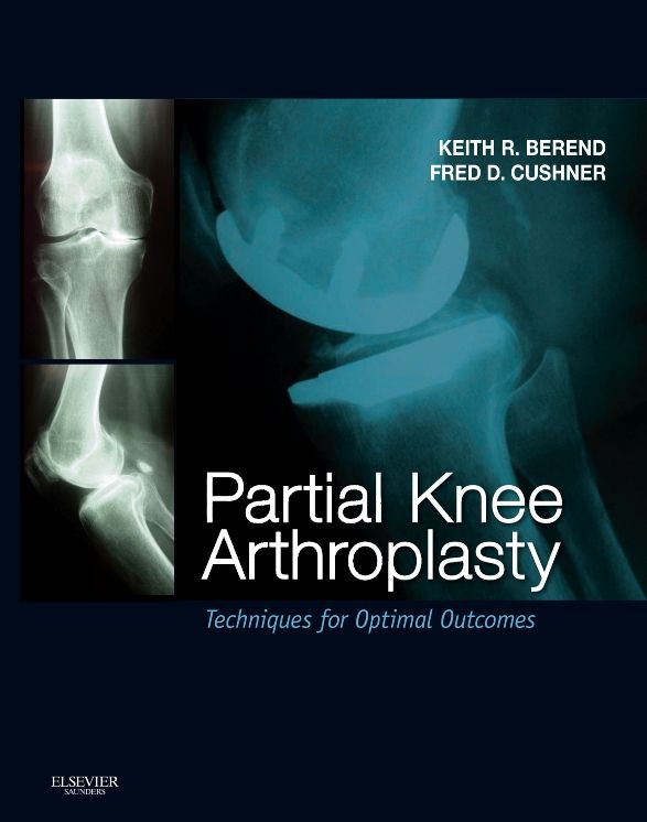 Partial Knee Arthroplasty E-Book: Techniques and Optimal Outcomes - Expert Consult