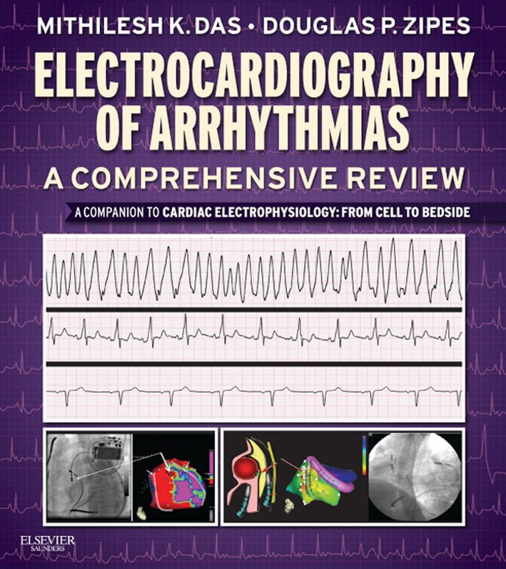 Electrocardiography of Arrhythmias: A Comprehensive Review E-Book: A Companion to Cardiac Electrophysiology