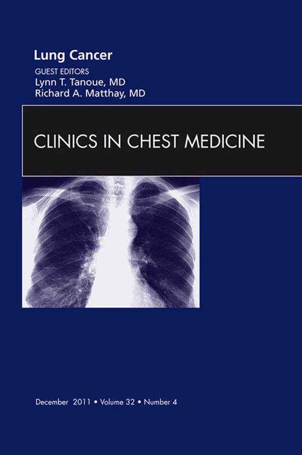 Lung Cancer, An Issue of Clinics in Chest Medicine - E-Book