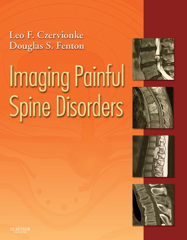 Imaging Painful Spine Disorders E-Book
