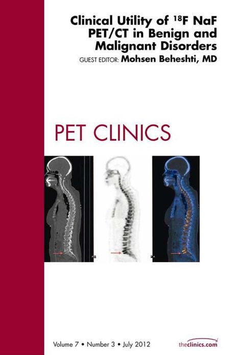 Clinical Utility of 18NaF PET/CT in Benign and Malignant Disorders, An Issue of PET Clinics - E-Book