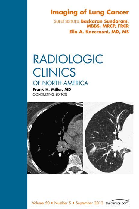 Imaging of Lung Cancer, An Issue of Radiologic Clinics of North America - E-Book