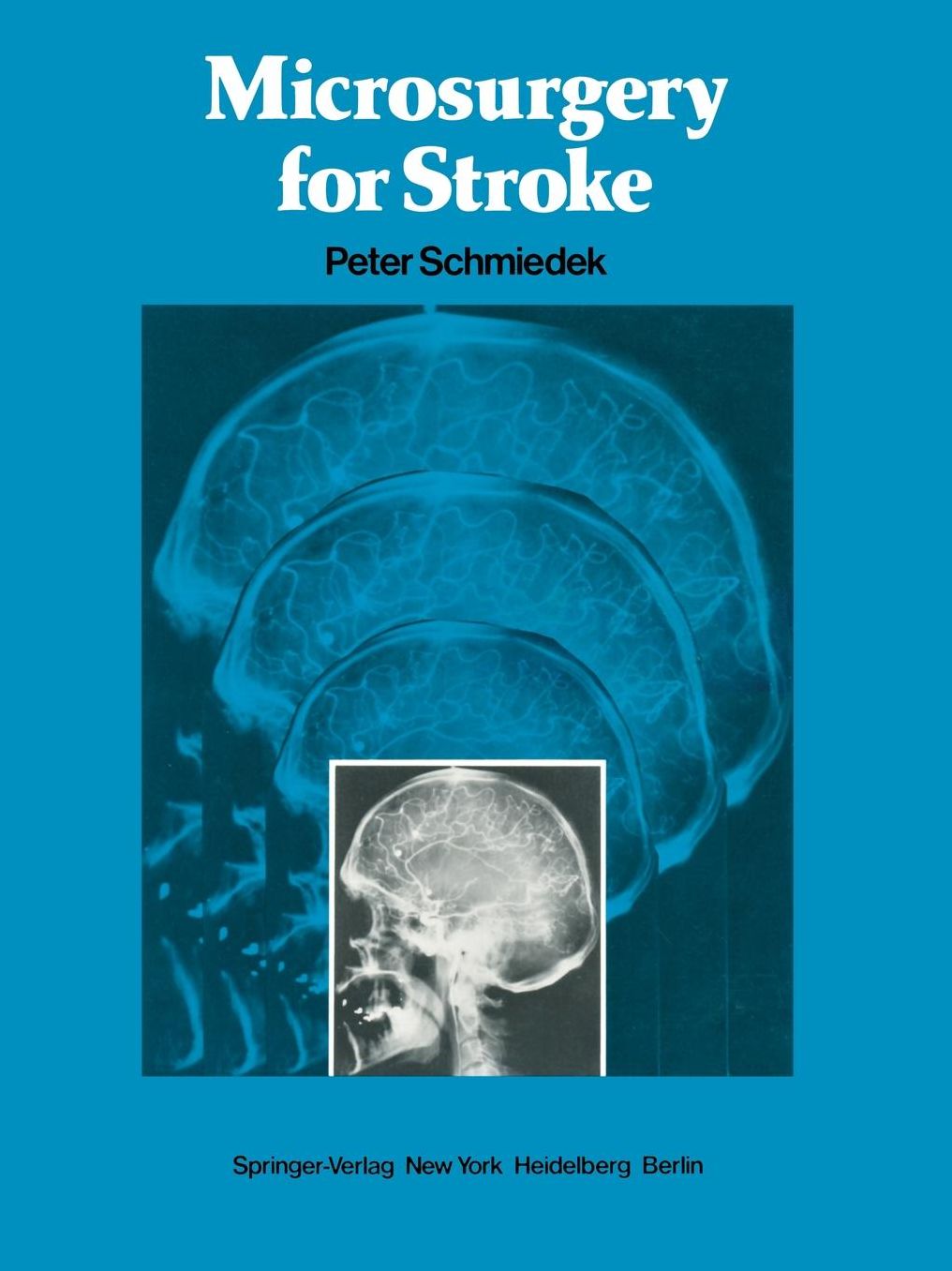 Microsurgery for Stroke