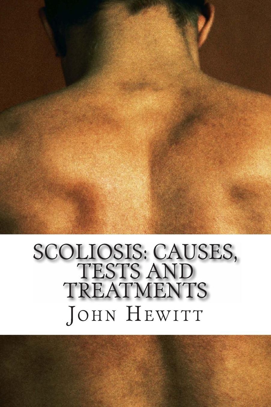Scoliosis: Causes, Tests and Treatments