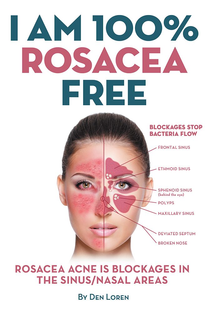 I Am 100% Rosacea Free: Rosacea Acne Is Blockages in the Sinus/Nasal Areas