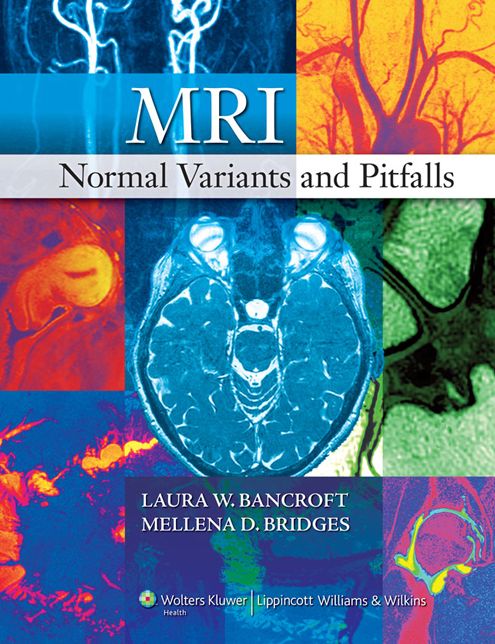 MRI Normal Variants and Pitfalls