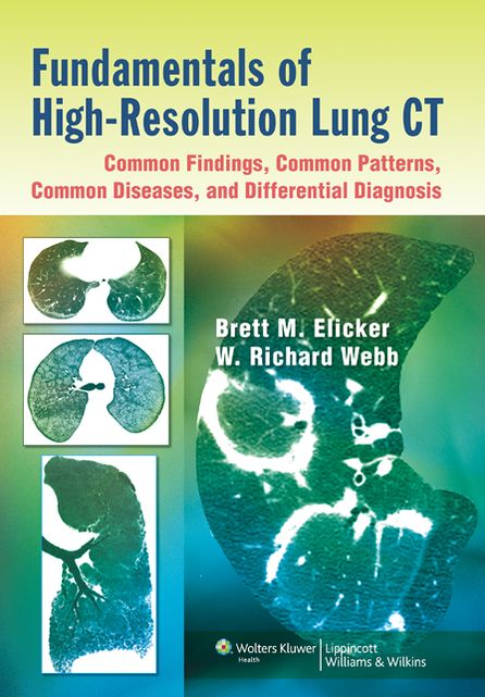 Fundamentals of High-Resolution Lung CT: Common Findings, Common Patterns, Common Diseases, and Differential Diagnosis: Common Findings, Common Patters, Common Diseases and Differential Diagnosis