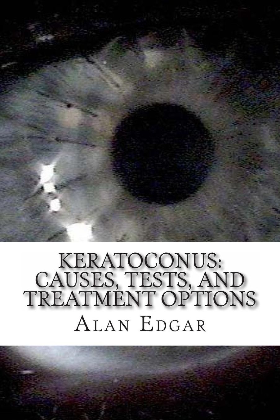 Keratoconus: Causes, Tests, and Treatment Options