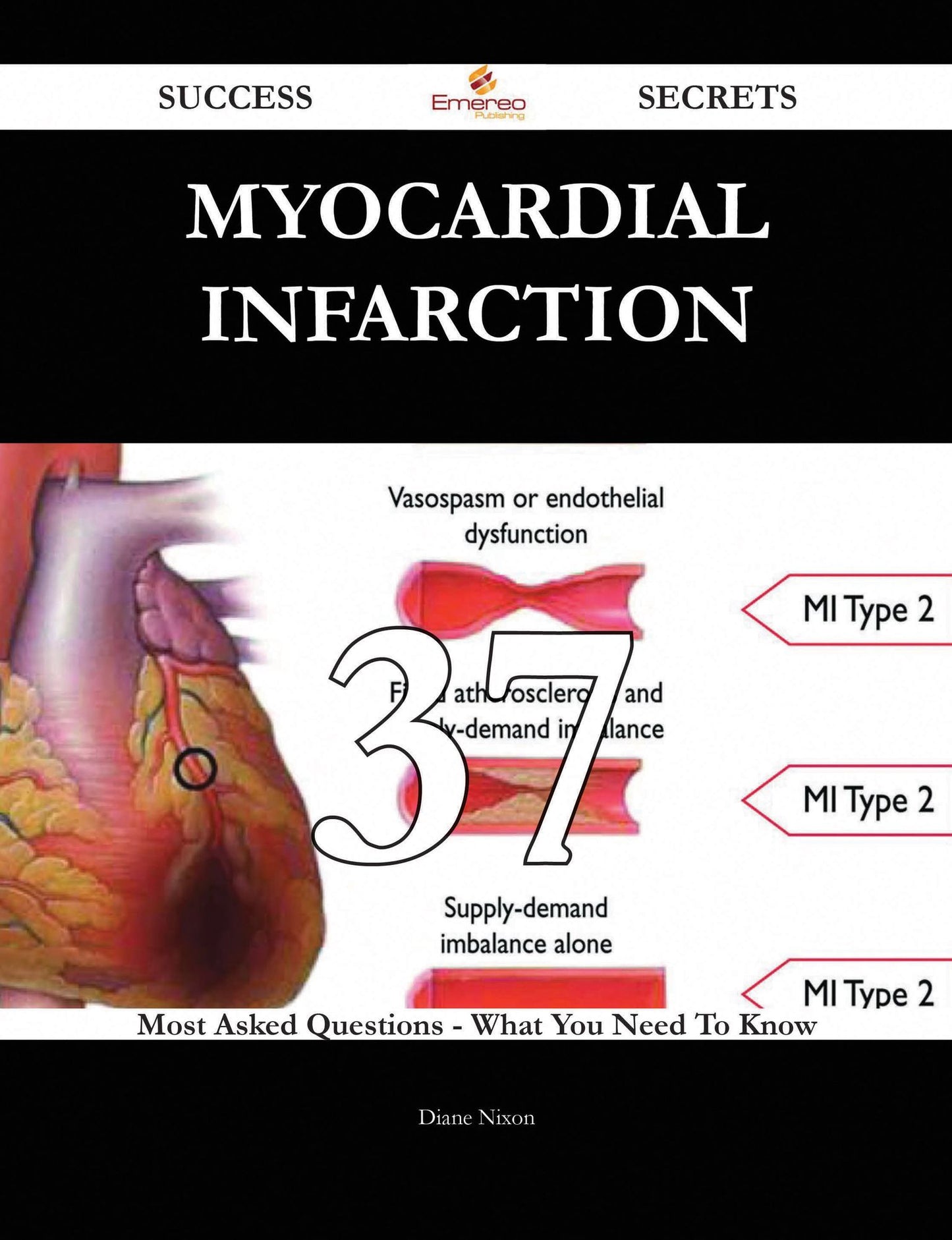 Myocardial infarction 37 Success Secrets - 37 Most Asked Questions On Myocardial infarction - What You Need To Know