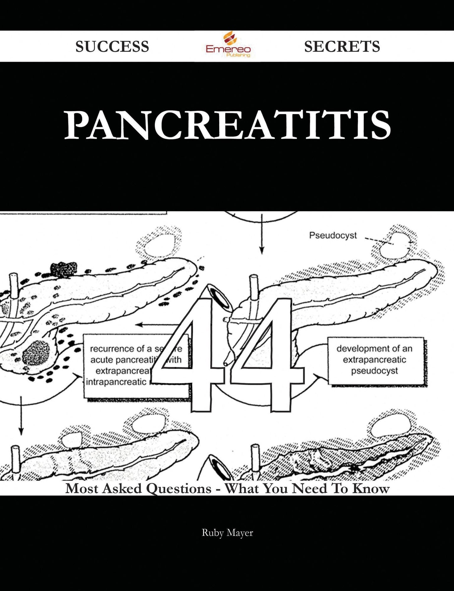 Pancreatitis 44 Success Secrets - 44 Most Asked Questions On Pancreatitis - What You Need To Know