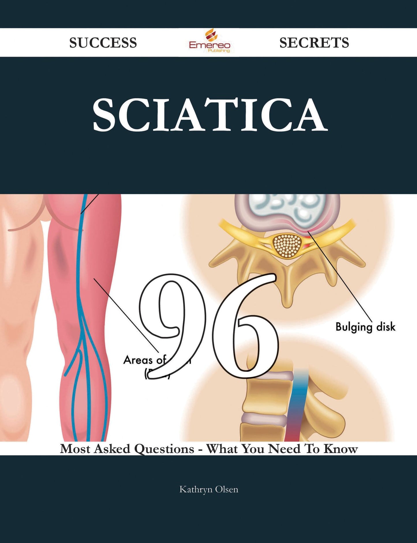 Sciatica 96 Success Secrets - 96 Most Asked Questions On Sciatica - What You Need To Know