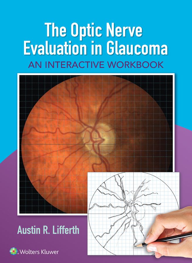 The Optic Nerve Evaluation in Glaucoma: An Interactive Workbook