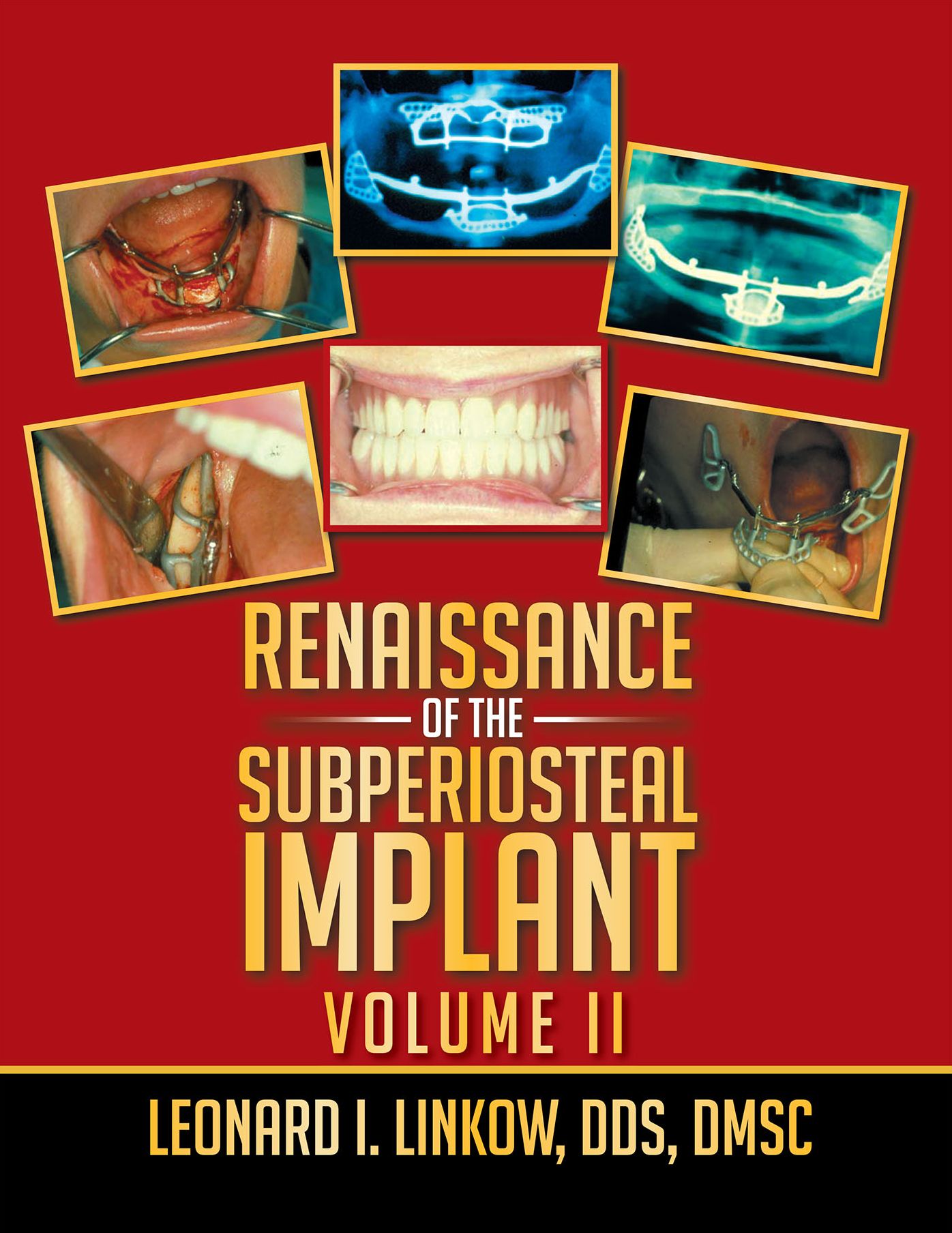Renaissance of the Subperiosteal Implant: Volume Ii