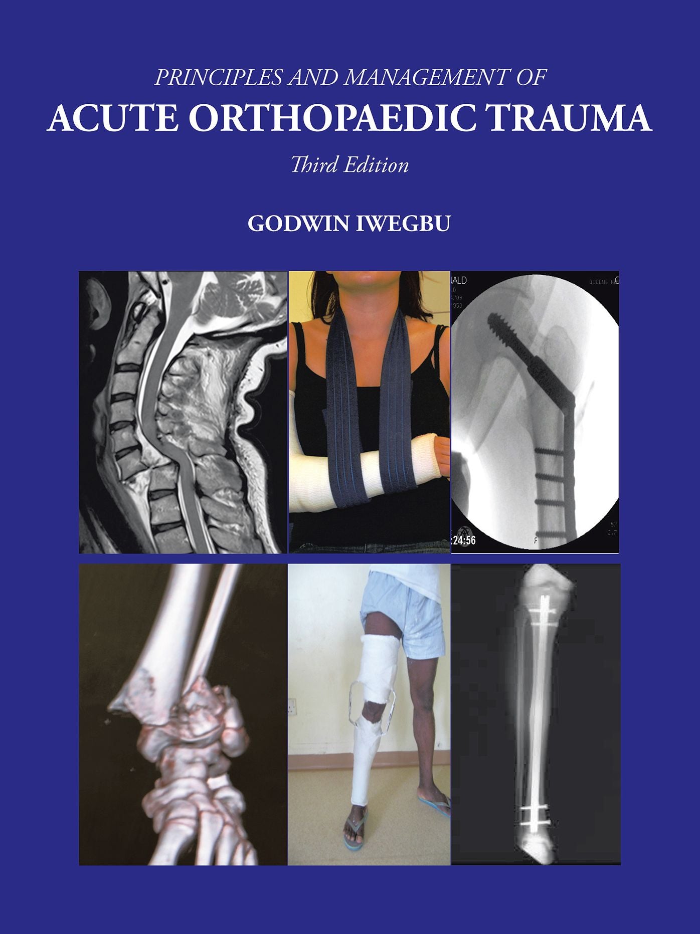PRINCIPLES AND MANAGEMENT OF ACUTE ORTHOPAEDIC TRAUMA: Third Edition