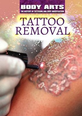 Tattoo Removal