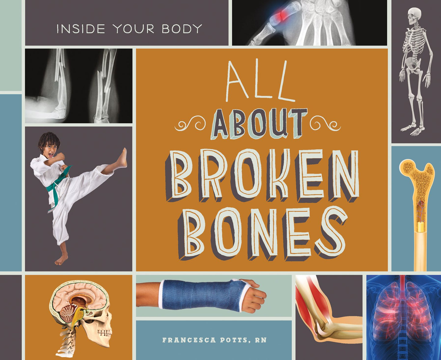 All about Broken Bones