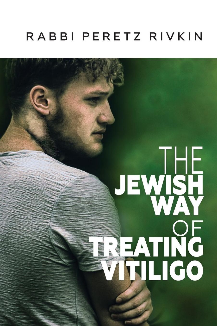 The Jewish Way of Treating Vitiligo