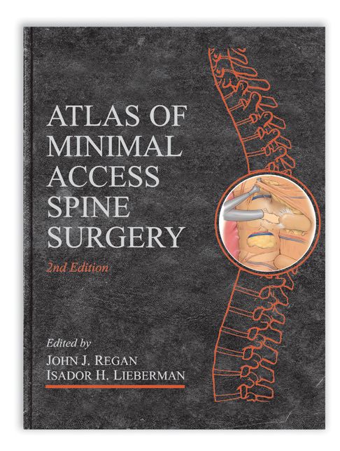 Minimal Access Spine Surgery