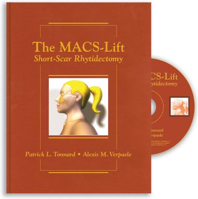 MACs-Lift Short Scar Rhytidectomy