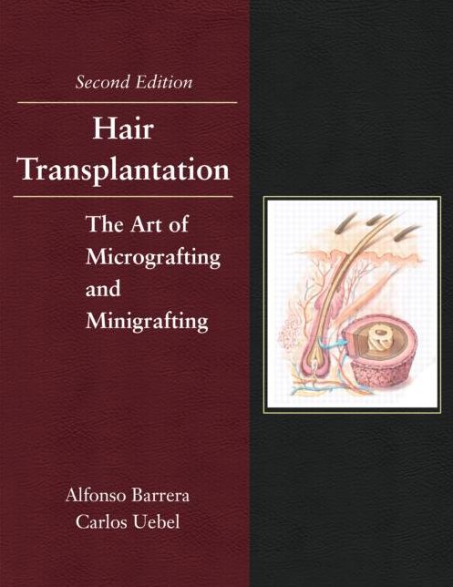 Hair Transplantation: The Art of Micrografting and Minigrafting, Second Edition