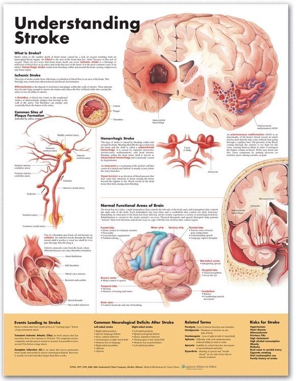 Understanding Stroke Anatomical Chart