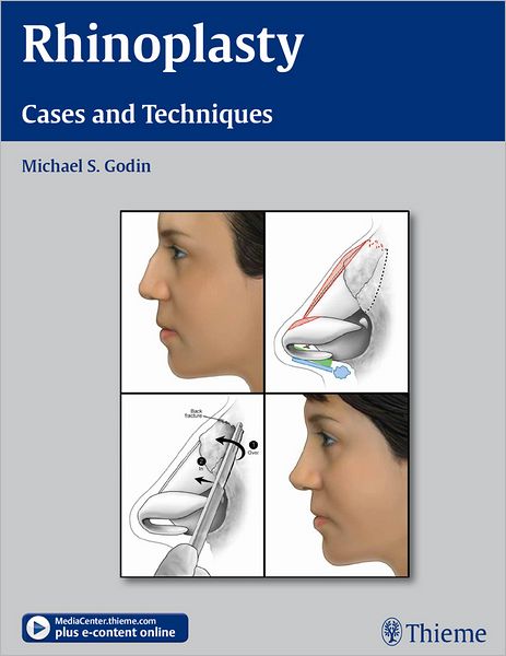 Rhinoplasty: Cases and Techniques