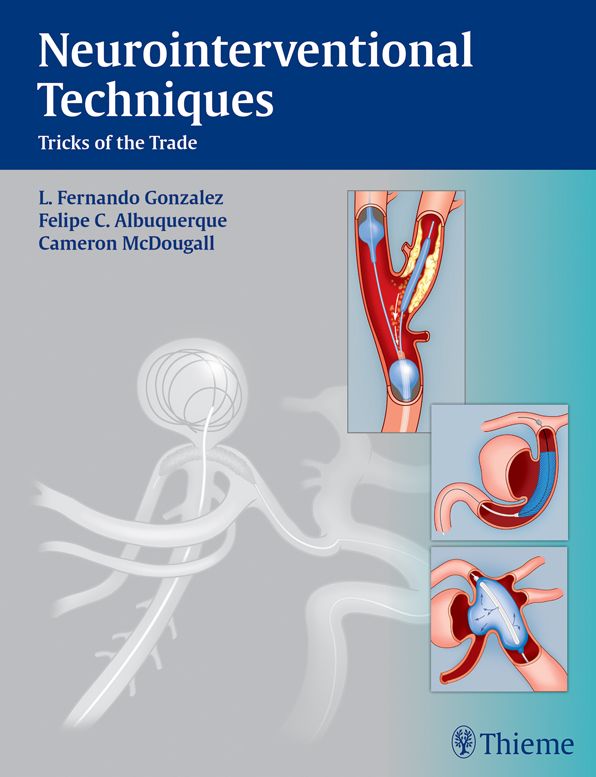 Neurointerventional Techniques: Tricks of the Trade