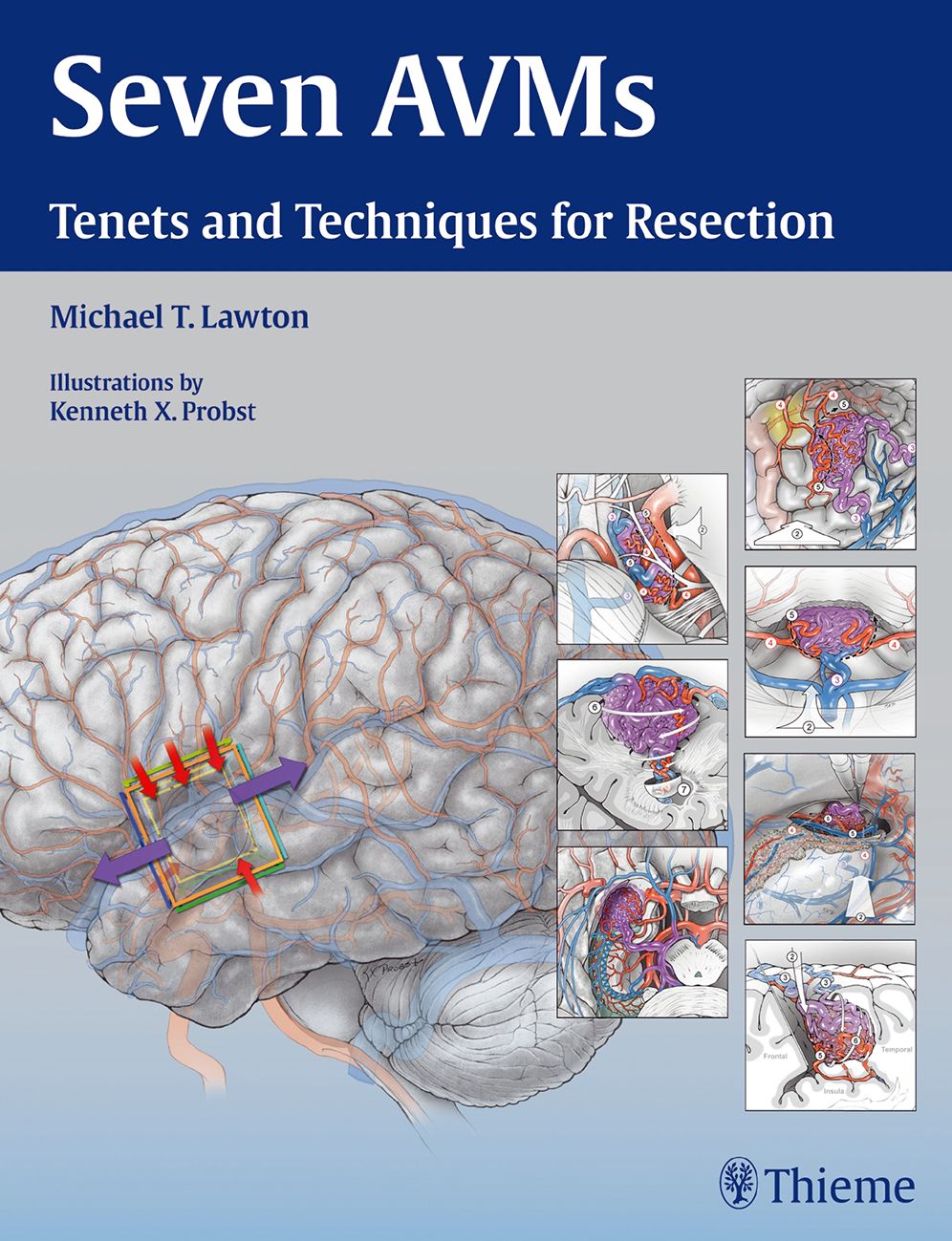 Seven AVMs: Tenets and Techniques for Resection