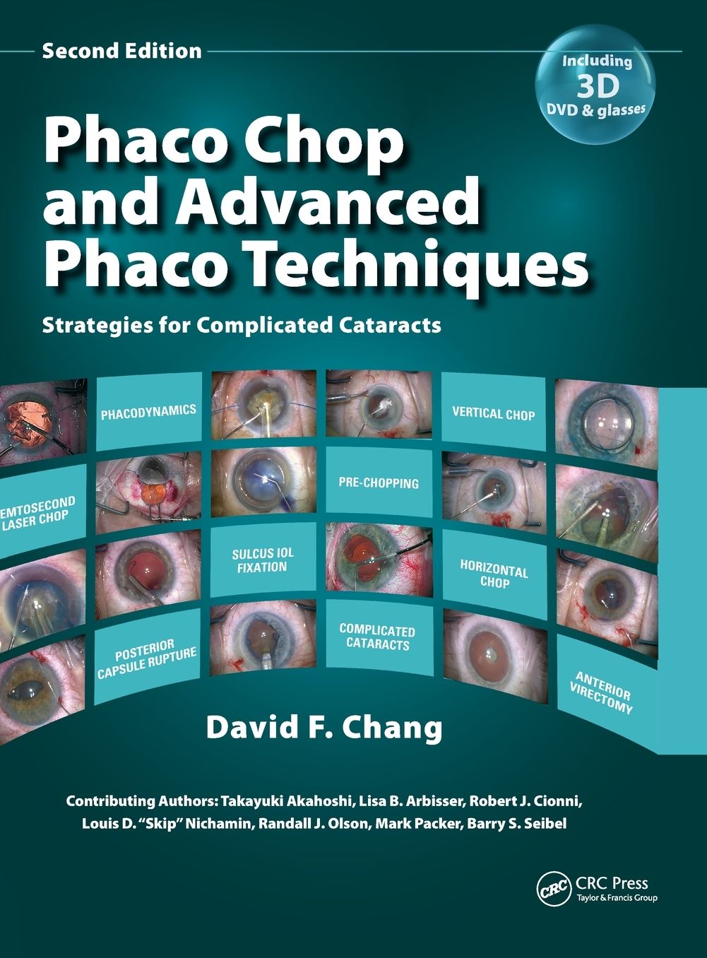 Phaco Chop and Advanced Phaco Techniques: Strategies for Complicated Cataracts