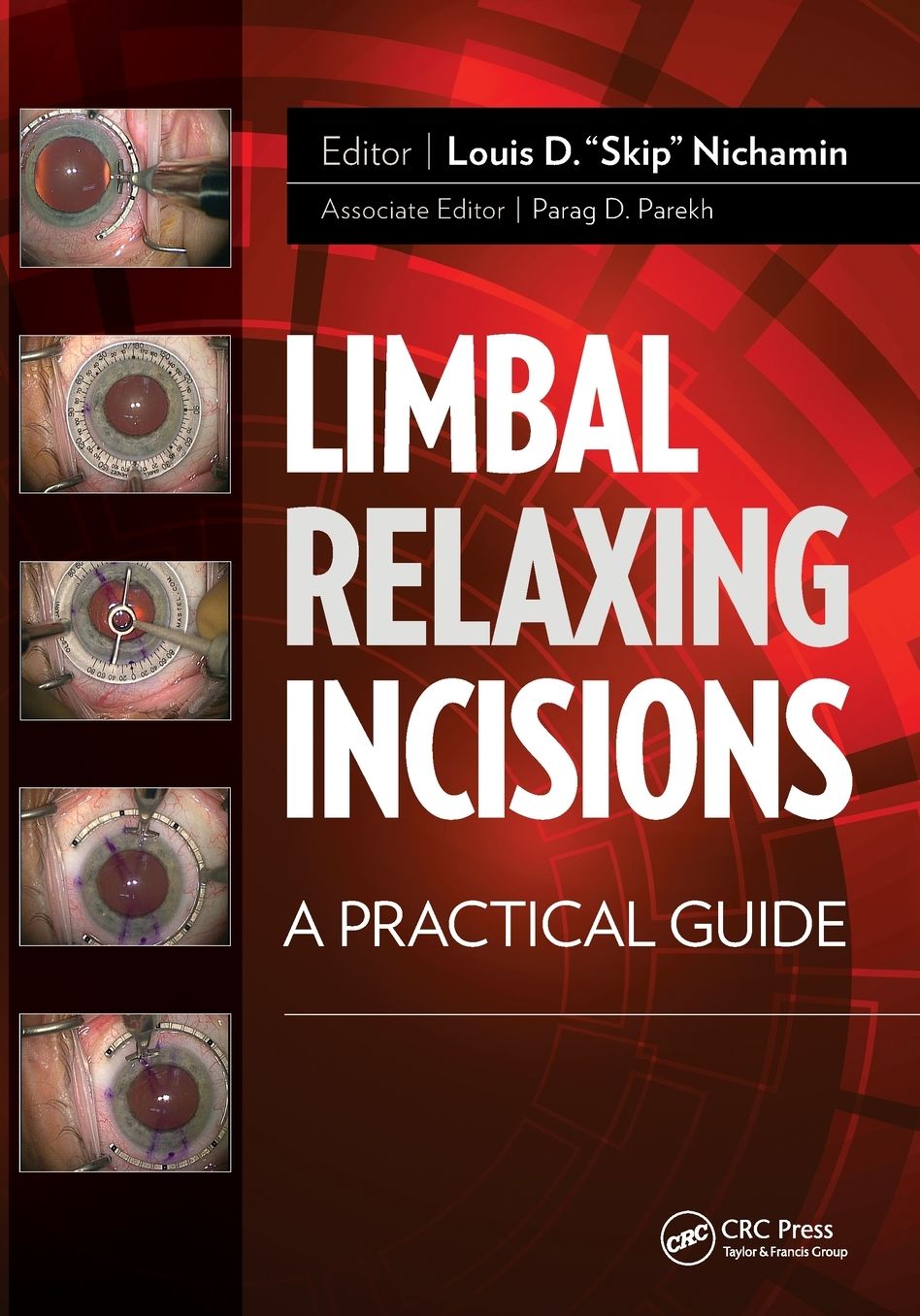 Limbal Relaxing Incisions: A Practical Guide