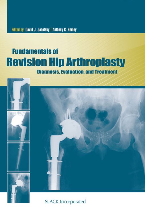 Fundamentals of Revision Hip Arthroplasty: Diagnosis, Evaluation, and Treatment
